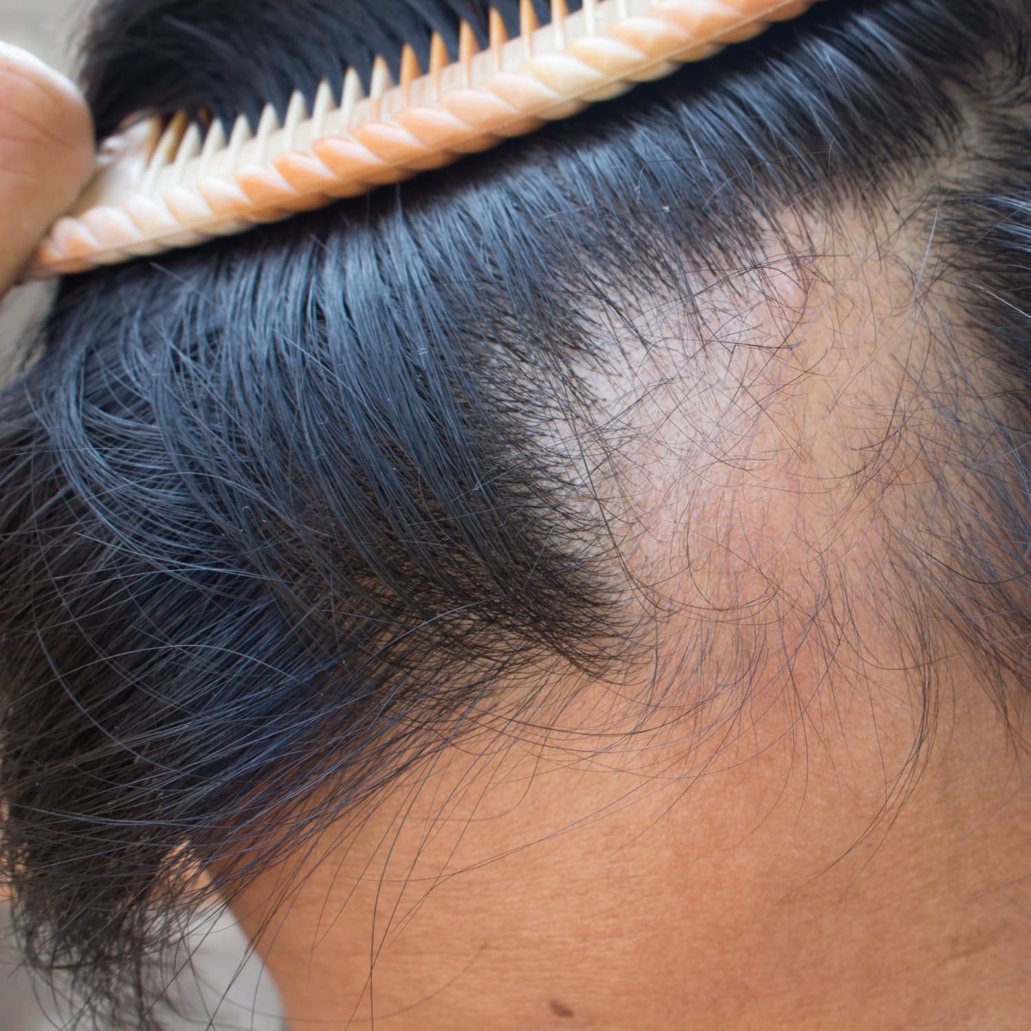 Homeopathic Doctor for Hair Loss Gurgaon  Hair Loss Treatment in Gurgaon