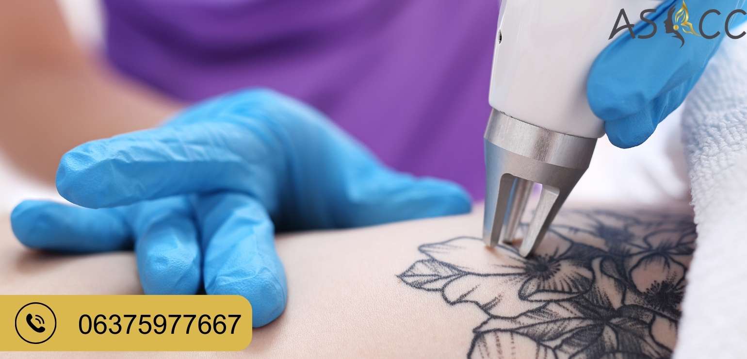 Permanent Tattoo Removal In Chennai