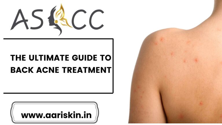 Read more about the article The Ultimate Guide to Back Acne Treatment