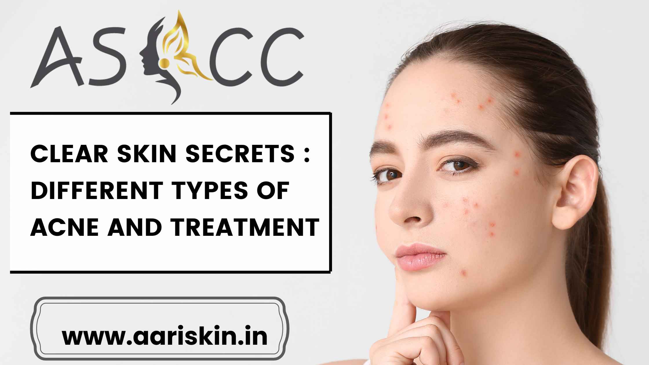 Read more about the article Clear Skin Secrets : Different Types of Acne and Treatment