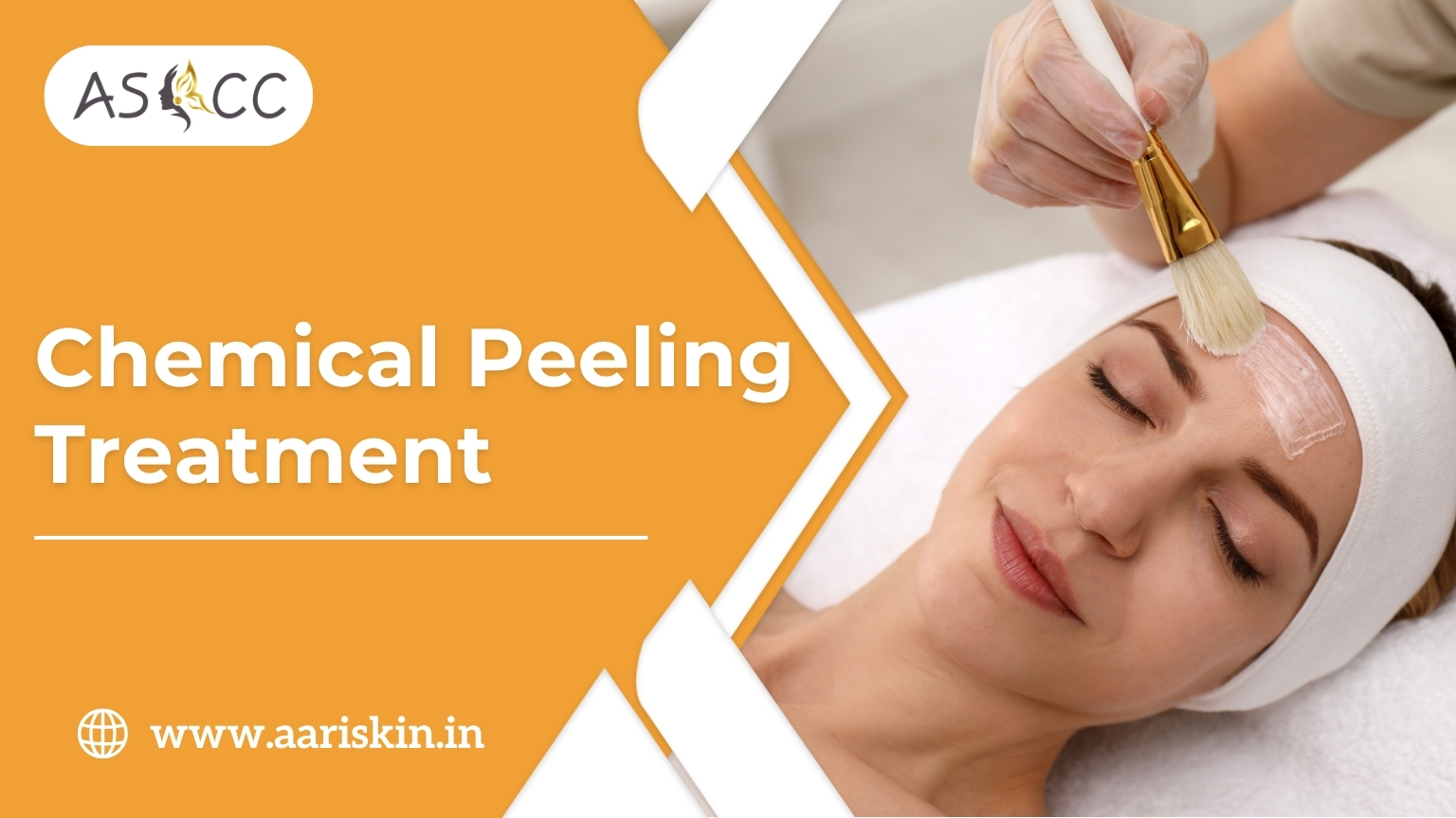 Read more about the article Chemical Peeling treatment