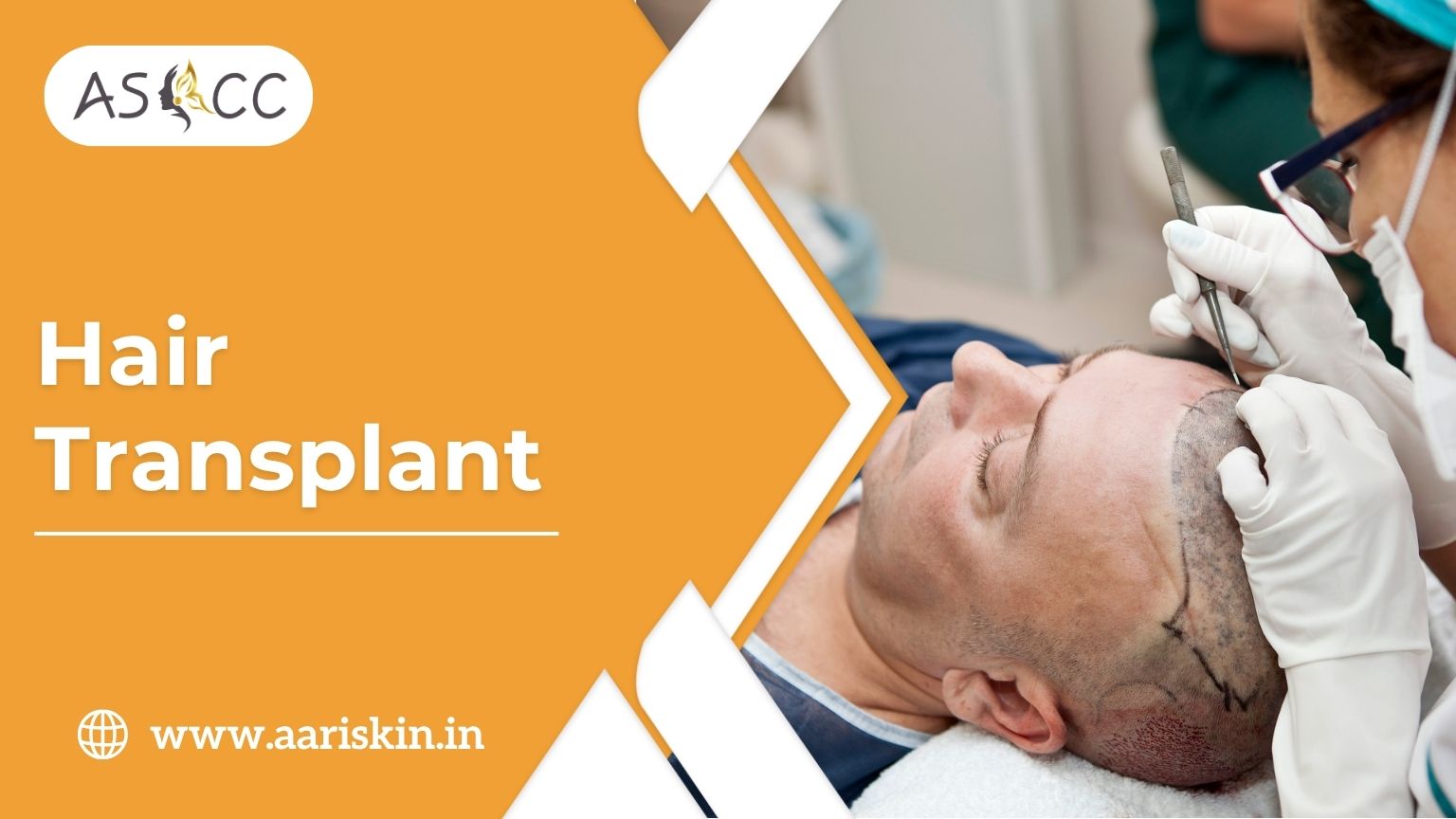 Read more about the article Hair Transplant in Jaipur