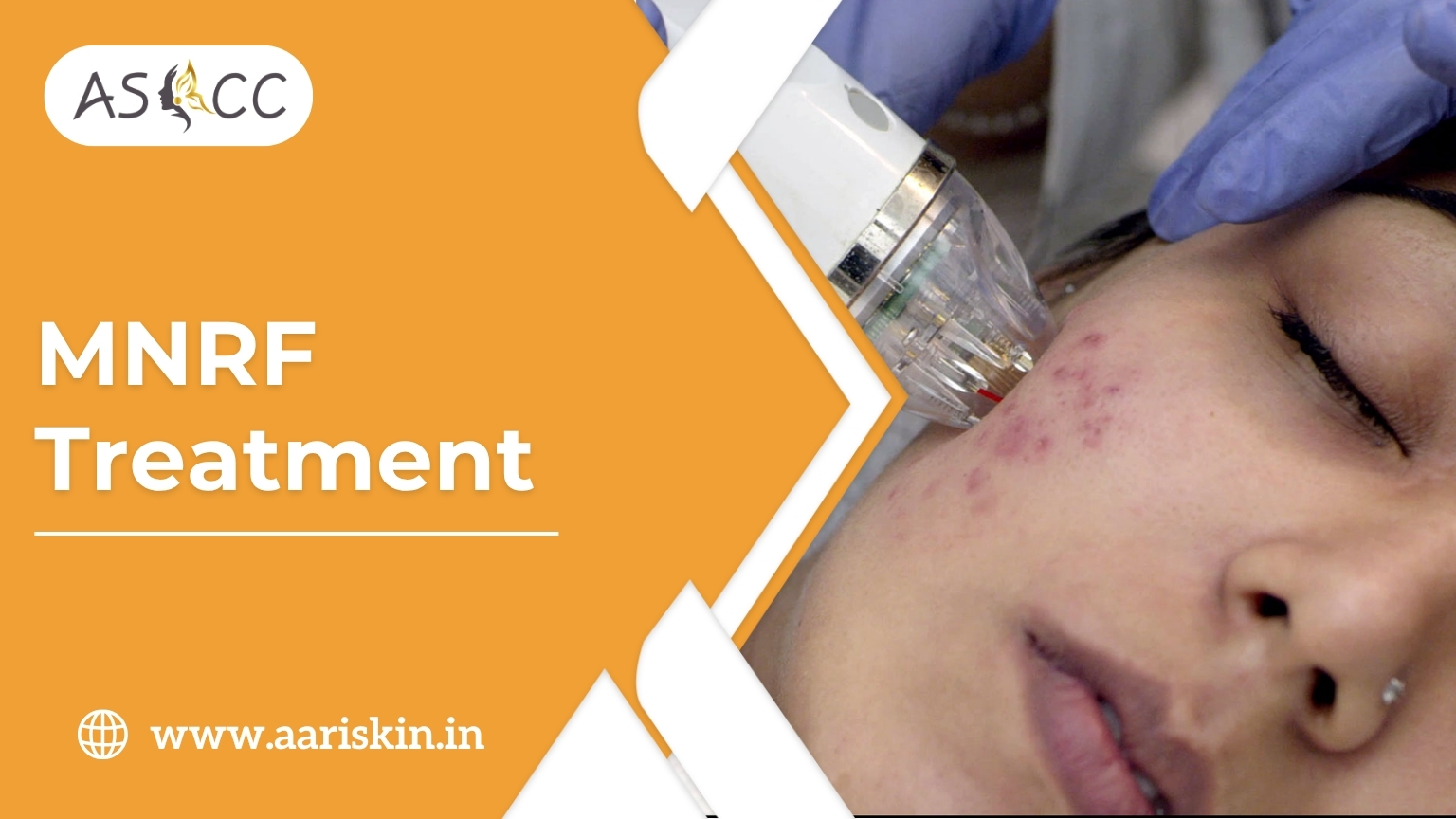 Read more about the article MNRF Treatment in Jaipur